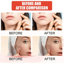 240pcs Star Acne Patches Invisible Pimple Cover for Face Oil Control